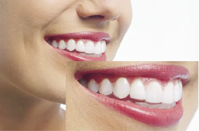 イメージ：矯正中の見た目の不安は？1